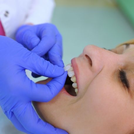 Califon cosmetic dentist placing a veneer over a tooth