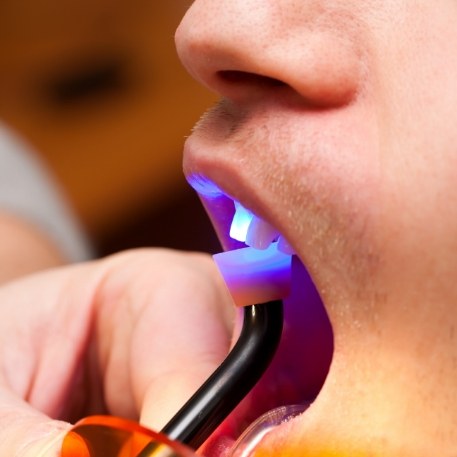 Close up of dental patient getting cosmetic dental bonding on upper tooth