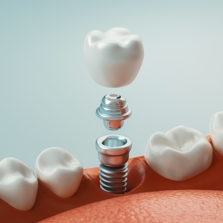 Illustrated dental implant with crown and abutment