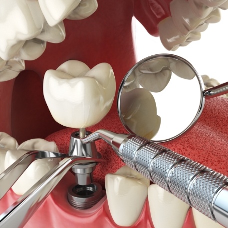 Illustrated dental implant being placed into the lower jaw