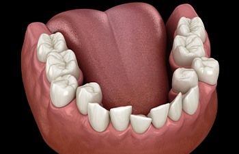 Illustration of crowded teeth