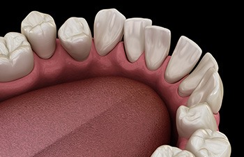 Illustration of gapped teeth