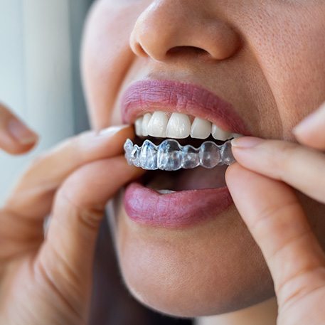 Closeup of patient putting on clear aligner