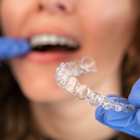 Dentist putting clear aligner on patient's top teeth