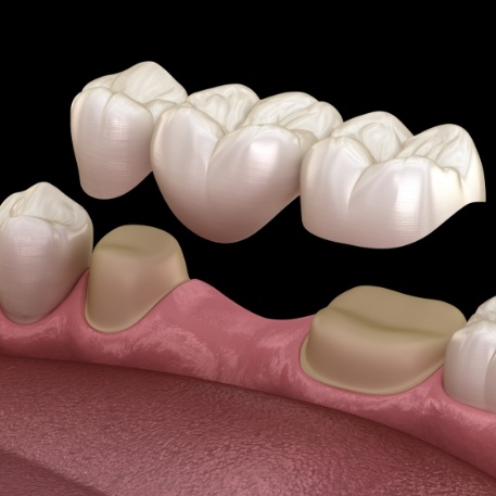 Illustrated dental bridge replacing a missing tooth in Califon