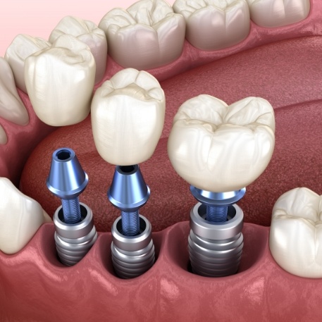 Three dental crowns being placed onto three dental implants