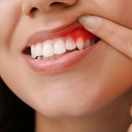 Close up of person pointing to red spot in their gums