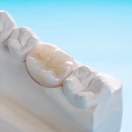 Dental crown over a tooth in a model of the mouth