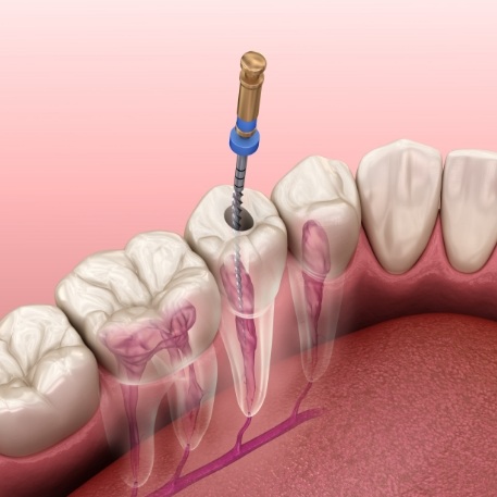 Illustrated dental instrument cleaning inside of tooth during root canal treatment