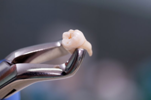 Close up of an extracted tooth